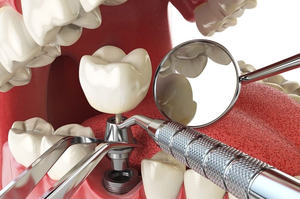 ایمپلنت دندان‌های مفقود شده و عصب‌کشی دندان: ۲ راه حل پایدار برای بهبود کیفیت زندگی شما