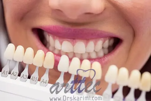 How long is dental laminate