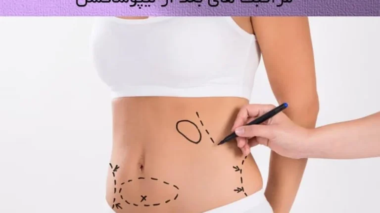 مراقبت بعد از عمل لیپوساکشن