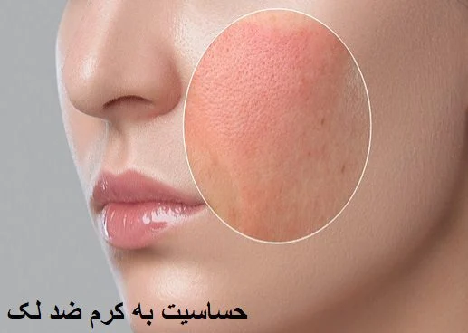 &nbsp;آیا استفاده از کرم ضد لک باعث آلرژی می شود؟