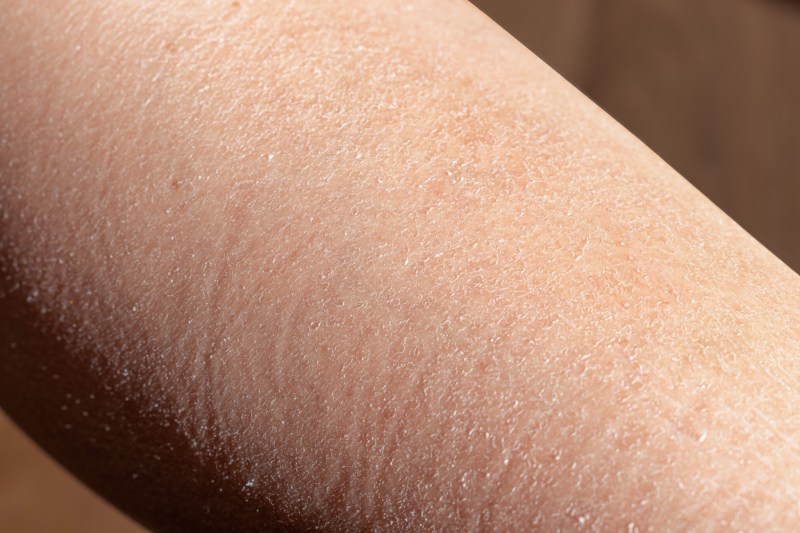 دلایل شایع خشکی و پوسته‌ ریزی پوست + درمان و پیشگیری